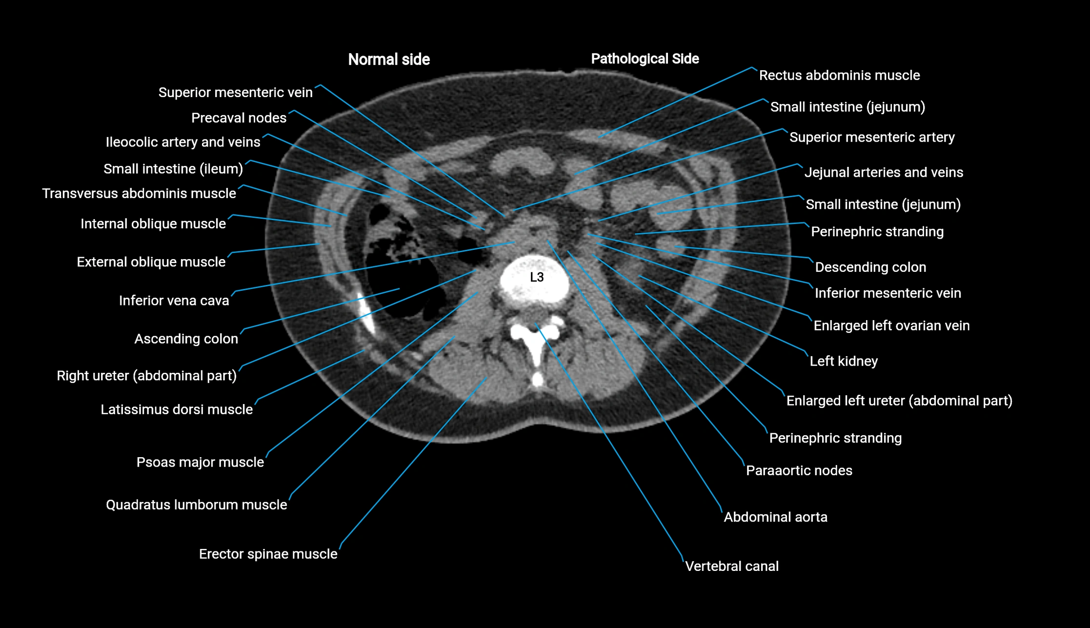 CT KUB axial cross sectional anatomy  radiology image -img-00201-00065.webp